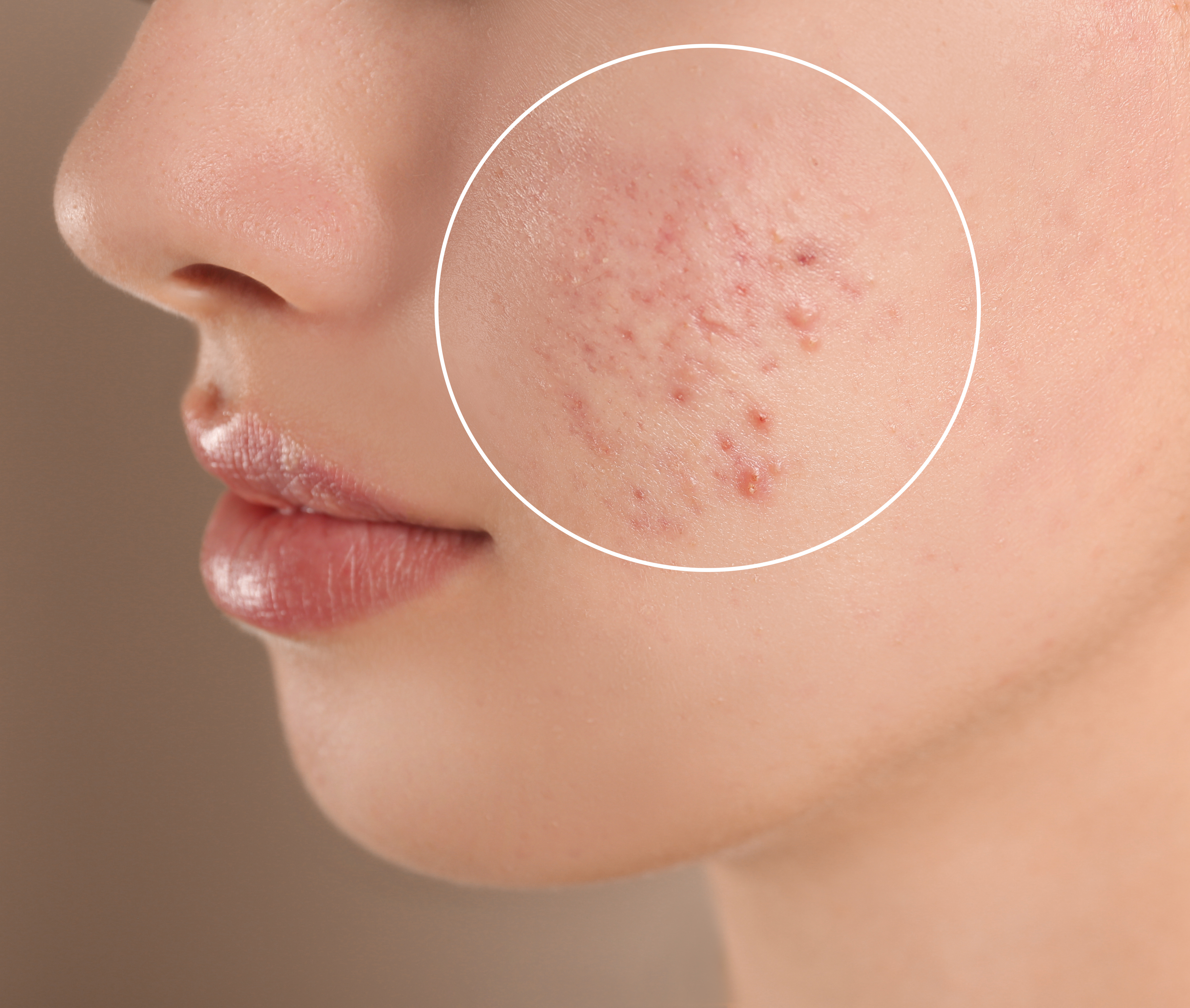Acne Care Plus Image 2